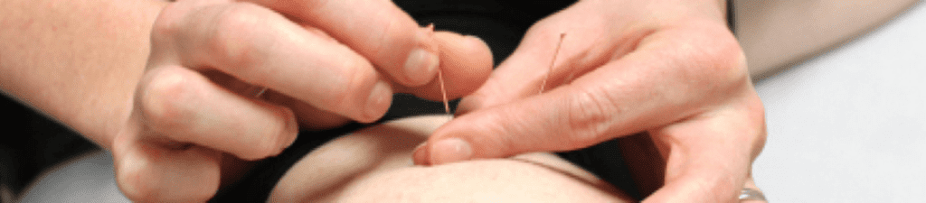 how-can-dry-needling-help-my-injury-image