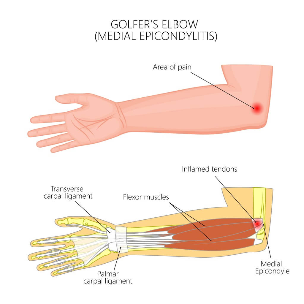 golfers-elbow-treatment