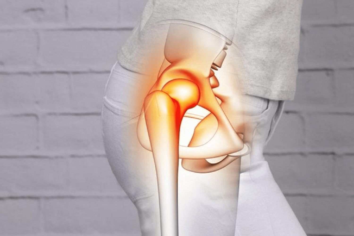hip-impingement-physiotherapy-sydney