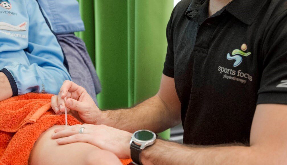 Advantages Of Dry Needling